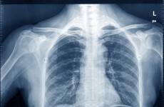 'It is a real tragedy for us': X-ray mistake led to delayed cancer diagnosis
