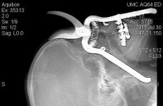 Man survives being impaled on pruning shears... through eye socket