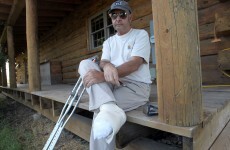 Trapped lumberjack cut off five of his own toes to free himself