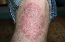 Do you suffer with psoriasis? A new drug treatment could offer you great news