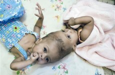 UK surgeons separate twin girls joined at head