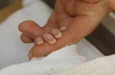 Need for discussions between hospitals and Jehovah's Witness patients