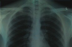 Light alcohol consumption could help reduce asthma risk, says study