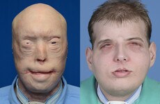 "There is hope": This man just got the most extensive face transplant ever