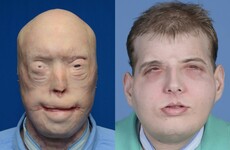 'It isn’t like Face/Off': The surgeon who performed this extreme face transplant explains how he did it