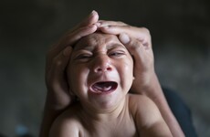 Severe birth defects and brain damage confirmed as linked to Zika virus