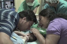 Conjoined baby girls separated in Chile