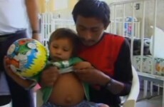 'Parasitic twin' with eyes and hair found in toddler's stomach