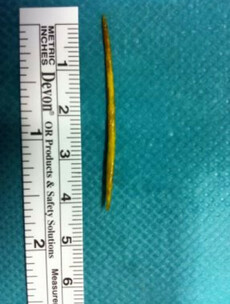 More common than you think: The potentially fatal consequences of swallowing a toothpick