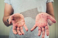 Numbers continuing to rise in Limerick measles outbreak as doctors urge vaccinations