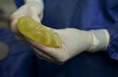 Defective breast implants could have been used in Irish clinics before 2001