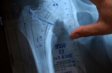 Irish recipients of defective hip implants to sue manufacturer
