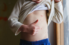 Am I being a bad parent... by not wanting a child with chickenpox in my son's playgroup?