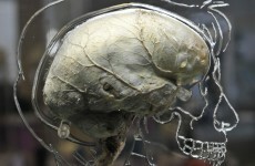Almost 60 per cent more women than men dying from stroke