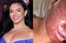 Everything you need to know about that terrifying looking facial Alexandra from Love Island had