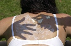 100 deaths from melanoma every year in Ireland