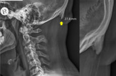 Factcheck: Are horns growing on young people's skulls because of mobile phone use?