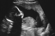 Unborn babies could be tested for 3500 genetic conditions