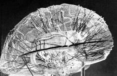 Dublin to host international congress on Parkinson's disease