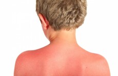 Warning to protect children in the sun as 90% of 10-17 year olds say they've had sunburn at least once