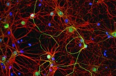 Rare gene mutation might defend against Alzheimer's disease