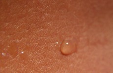 People living with psoriasis 'avoid social situations'