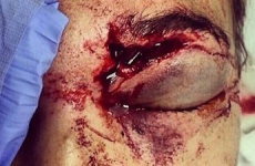 Ouch! Here's your don't stand in the way of a golf ball picture of the day