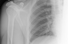 NI X-ray delay meant two late cancer diagnosis cases