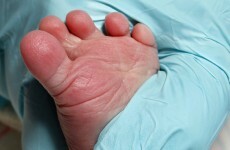 Warning given ahead of destruction of heel prick tests results