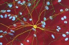 Scientists identify early predictors for Huntington's disease