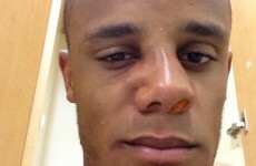 Vincent Kompany played on with a concussion last night
