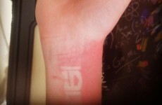 Irish man gets boyband themed sunburn