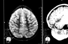 Explainer: What is Creutzfeldt-Jakob disease?