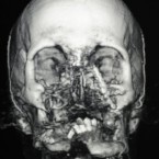 'Oscar's' injuries before the face transplant.