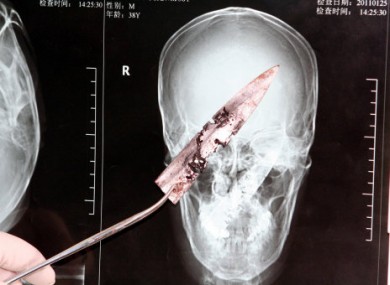 A Chinese doctor shows the rusted knife blade against an x-ray of Ni's head.