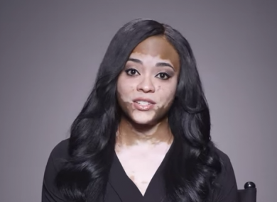 Cheri Lindsay, who has vitiligo